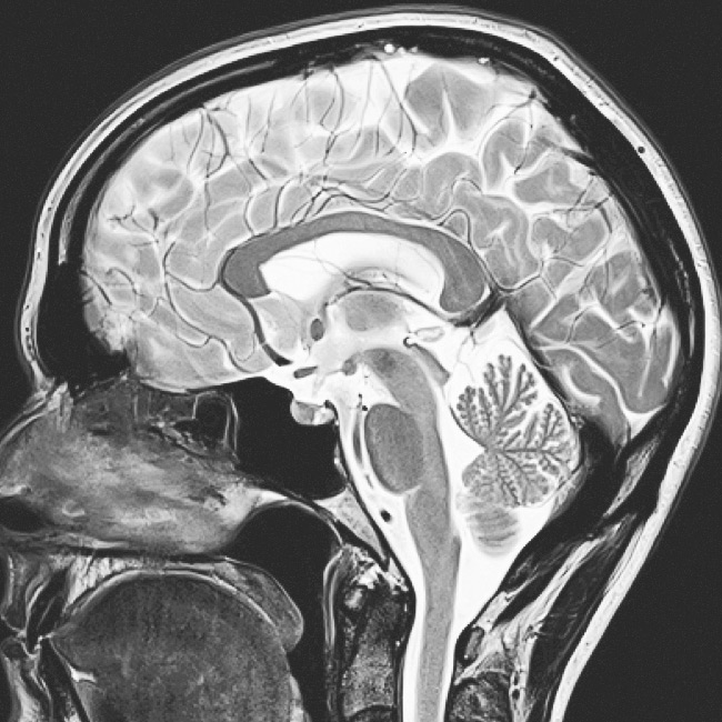 МРТ головного мозку